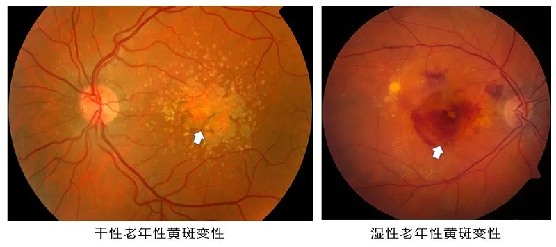 水蛭素、黃斑變性