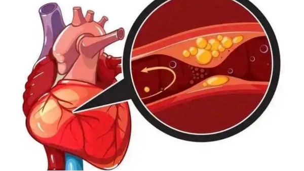 真實案例：是什么讓他堅持一年，冠狀動脈堵塞消除30%！