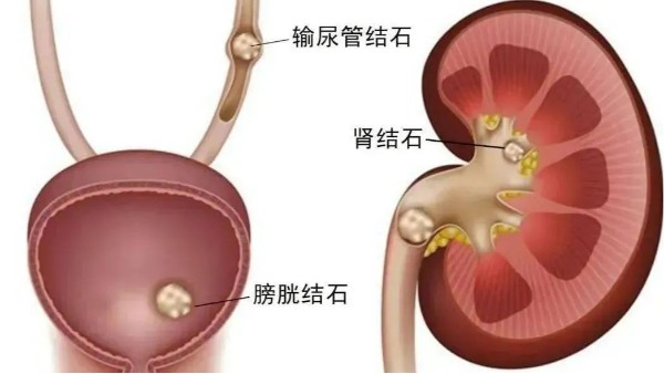 重用、活用水蛭治療尿路結(jié)石，療效較好