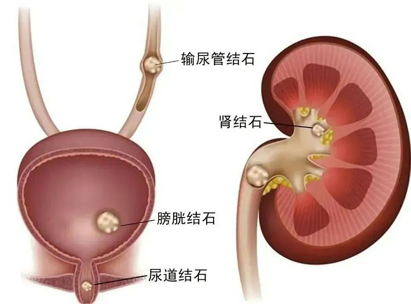 水蛭素、尿路結石、腎功能