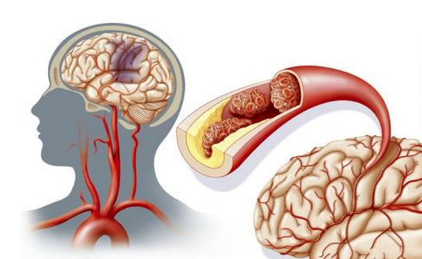 水蛭素、急性腦梗死、中風