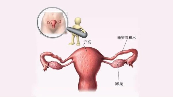 水蛭有利水道、破積聚之功，可用于治療輸卵管積水