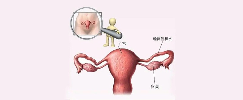 水蛭素、輸卵管積水、不孕不育