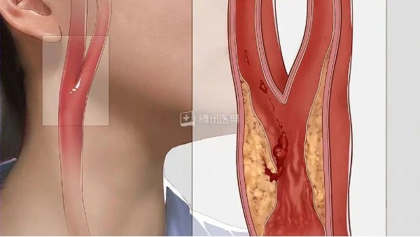 真實案例丨3個月左頸動脈狹窄降低約27%，是怎么實現(xiàn)的？