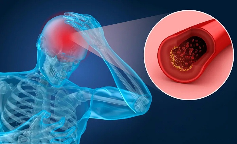 水蛭素、腦梗死、腦中風