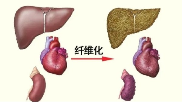 水蛭是臨床常用的活血藥物，能有效治療器官纖維化