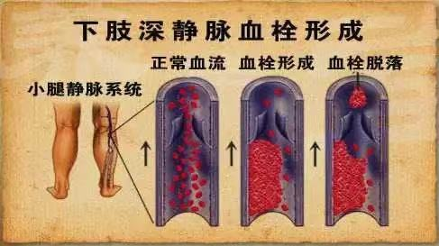 水蛭素、水蛭素膠囊、壯醫(yī)水蛭療法