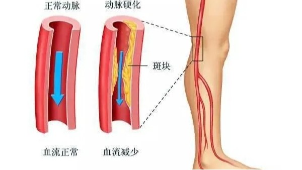 水蛭在改善下肢動(dòng)脈硬化性閉塞癥中發(fā)揮重要療效，安全性及可行性較高