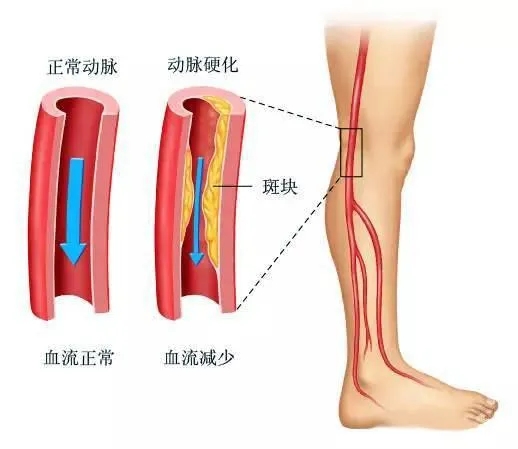 水蛭素、下肢動(dòng)脈硬化、下肢閉塞