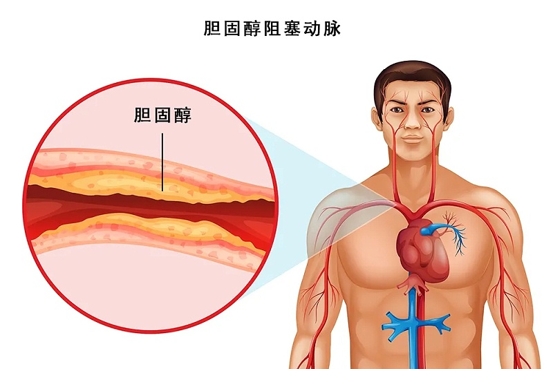 水蛭素、脖子粗、血管硬化