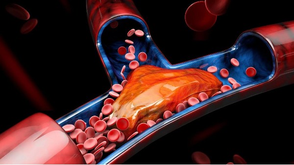 血栓最容易堵在身體3個(gè)地方！有這4個(gè)信號(hào)一定要留意→