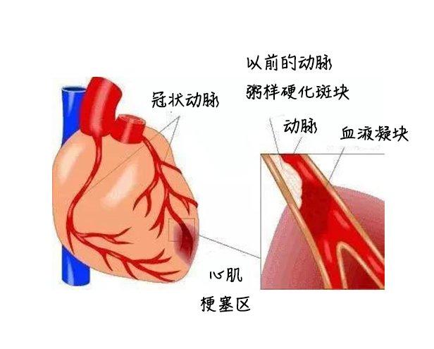 中醫(yī)藥健康旅游、心梗、面癱