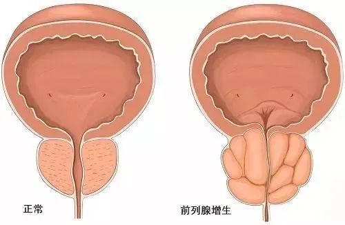 水蛭素、前列腺增生、前列腺肥大