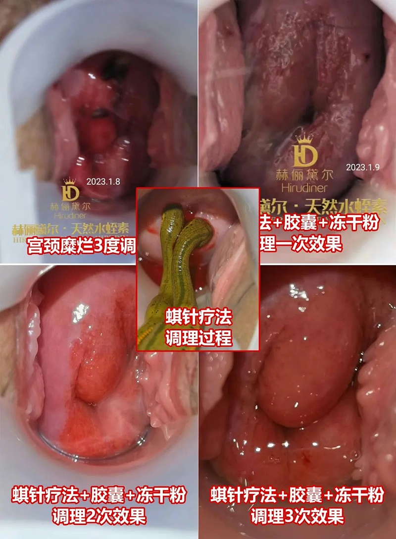 水蛭素、水蛭素膠囊、生殖婦科