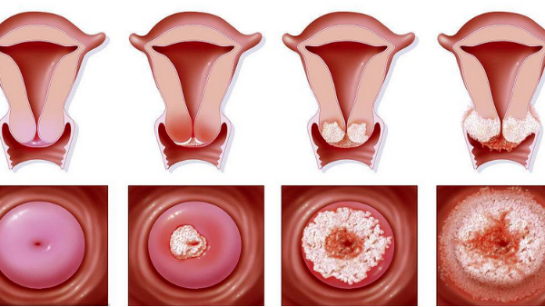 得了「宮頸糜爛」，怎么辦？