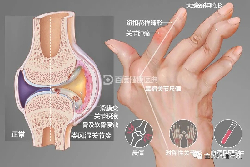 壯醫(yī)水蛭療法,天然水蛭素膠囊