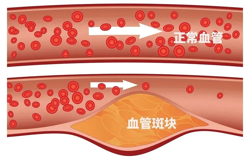 水蛭素、通血管、血管堵塞