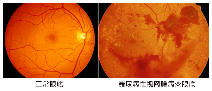 水蛭素、糖尿病、視網(wǎng)膜病變