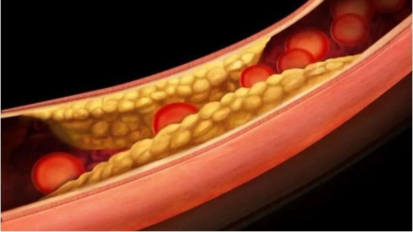 三高如何引起動脈粥樣硬化斑塊？——高血壓篇