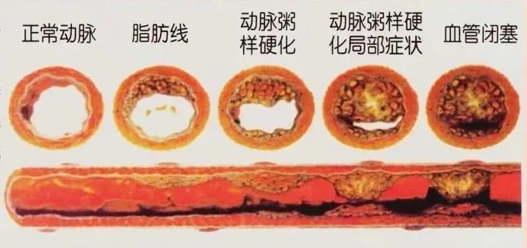 水蛭素、動脈粥樣硬化、高血壓