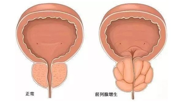 水蛭在改善前列腺增生臨床癥狀、提高生活質(zhì)量方面發(fā)揮重要作用