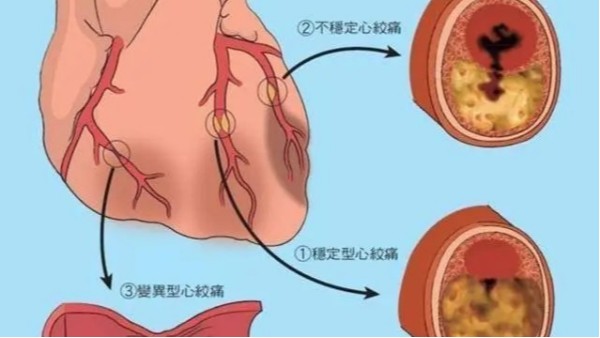 尿酸高不僅導(dǎo)致痛風(fēng)，還可能威脅你的心臟和大腦！